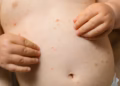 Early Stage Chicken Pox Rash in Babies: How to Spot It and What to Do