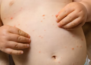 Early Stage Chicken Pox Rash in Babies: How to Spot It and What to Do