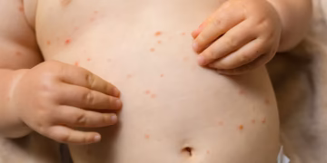 Early Stage Chicken Pox Rash in Babies: How to Spot It and What to Do