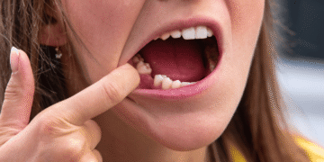 What Does a Normal Healing Socket Look Like After Tooth Extraction?