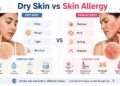 dry skin vs skin allergy